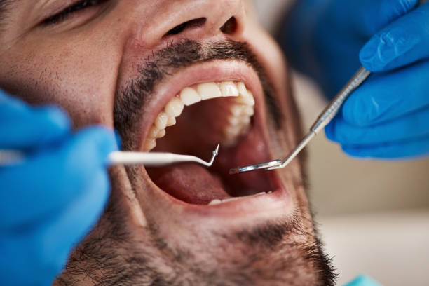 Best Emergency Tooth Extraction in Shawsville, VA