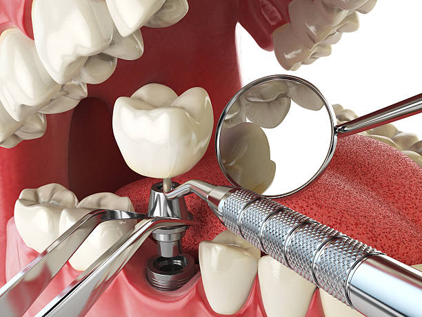 Best Emergency Root Canal Treatment in Shawsville, VA